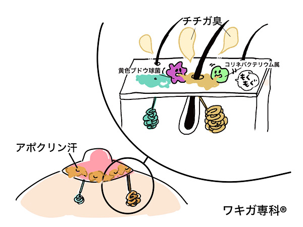 ワキガチチガくさい原因